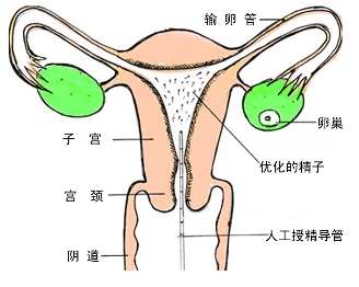 供精人工授精