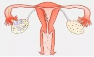 输卵管因素不孕
